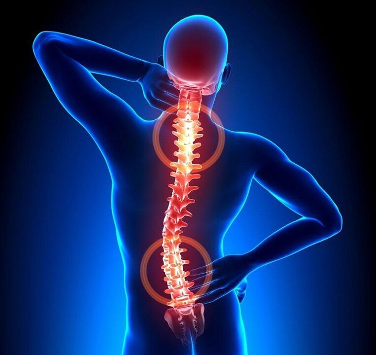 osteokondroza e shtyllës kurrizore si shkak i dhimbjes së shpinës