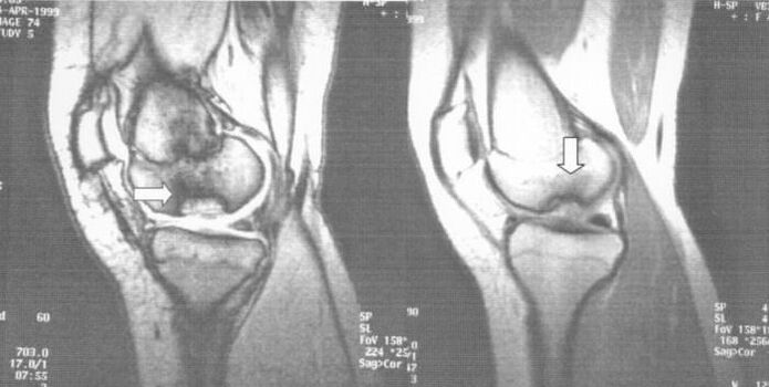 x-ray e osteokondrozës dissecans në nyjen e gjurit