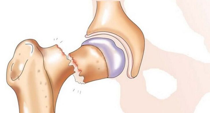 Një frakturë e qafës së femurit shoqërohet me dhimbje të forta në nyjen e hipit