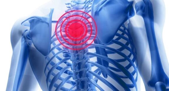 Trajtimi i osteokondrozës së shtyllës kurrizore të kraharorit