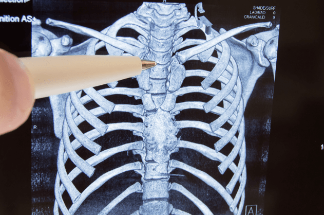 Osteokondrozë